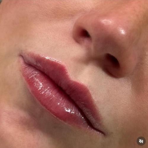 lip-filler