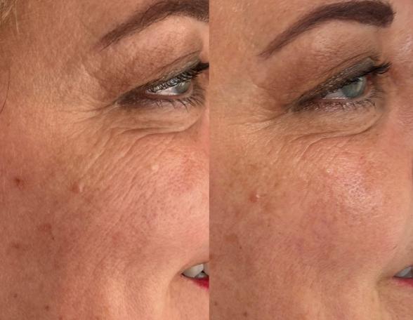 skin-boosters