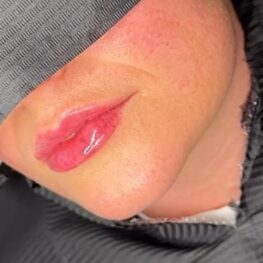 lip-injections